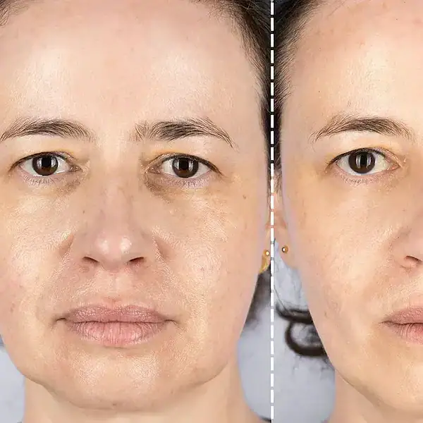 Confronto tra pelle del viso esposta e non esposta al sole con segni di invecchiamento cutaneo